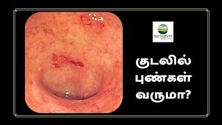 பெருங்குடலில் புண்கள் வருமா Ulcerative colitis Tamil by Dr Maran top Gastroenterologist in Chennai [upl. by Eamanna]