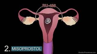 How Does the Abortion Pill Work 1st Trimester Medical Abortion Video [upl. by Acinomed713]