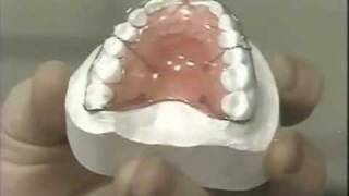 Diastema Closure  Hawley Retainer [upl. by Mosley]