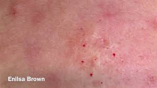 Gabrielas 2nd Acne Treatment Blackheads Extractions [upl. by Heilman]