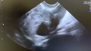 Ultrasound of 10 weeks unruptured ectopic pregnancy [upl. by Acirderf]