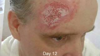 Time lapse video and pictures of Basal Cell Carcinoma removal skin cancer treatment no surgery [upl. by Rabkin]