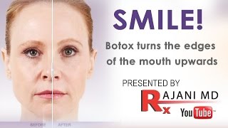 SMILEBotox Injected to Turn the Mouth UpwardsRajaniPortland [upl. by Pilar]