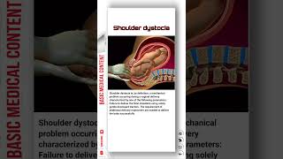 Shoulder Dystocia shoulder shoulderdystocia pregnancy [upl. by Ramey]