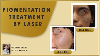 Pigmentation treatment by Q Switch Nd YAG Laser [upl. by Ginevra]