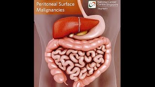 All About Peritoneal Tumours Causes Symptoms Diagnosis and Treatment [upl. by Jobina740]