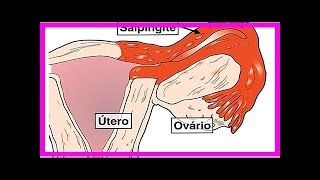 Erfahren Sie mehr über die Entzündungssymptome in den UterusEileitern [upl. by Klarrisa]