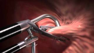 ROSE procedure  bariatric surgery revision [upl. by Nhguaved]