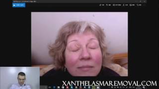 Xanthelasma Removal With TCA [upl. by Kinghorn59]