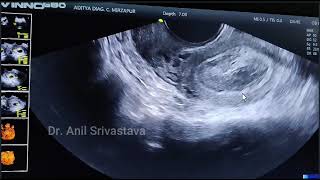 BICORNUATE BICOLLIS UTERUS WITH EARLY PREGNANCY [upl. by Iturhs336]