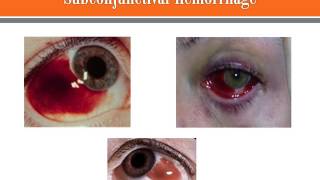 Subconjunctival Hemorrhage [upl. by Johan]