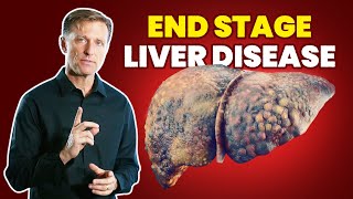 10 Signs of a Dying Liver End Stage Liver Disease [upl. by Yaned612]