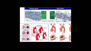 Aortopathy Symptoms and Causes  Diagnosis  Treatment  Prevention [upl. by Lara]