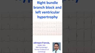 Right bundle branch block and left ventricular hypertrophy [upl. by Eolande510]