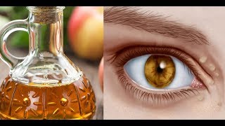 Natural Remedies to Cure Xanthelasma or Cholesterol Deposits Around the Eyes [upl. by Aredna]