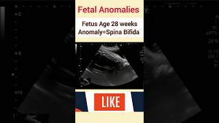 Fetal Anomaly ultrasound ultrasound fetaldevelopment fetalgrowth medical [upl. by Anitel595]