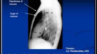 Chest Xray Lateral view [upl. by Libyc]