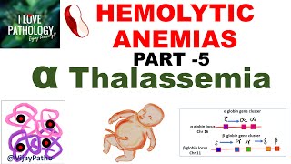 Hemolytic Anemias Part 5 Alpha Thalassemia Pathogenesis types Diagnosis amp Treatment [upl. by Esinej]