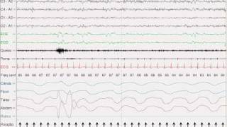 Estágio N0 e N1 do sono NREM [upl. by Fabiola]