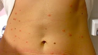 What is guttate psoriasis pictures symptoms stages photos and images [upl. by Ettenav]