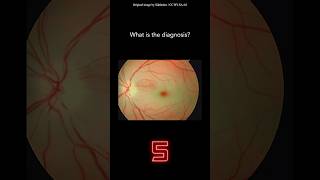 Fundoscopy Question 1 [upl. by Claudian]