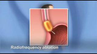 Treatments for Barretts Esophagus Dysplasia Esophagus Cancer adenocarcinoma  Mayo Clinic [upl. by Bekha]