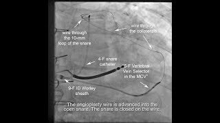 Antidromic snare  Venoplasty  use of micro catheter inside vein selector to traverse collaterals [upl. by Mcilroy490]