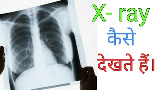 How to read Chest Xray  Hindi language [upl. by Aliuqahs992]