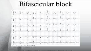 Bifascicular block [upl. by Anilad]