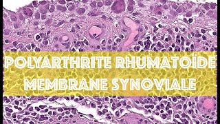 POLYARTHRITE RHUMATOÏDE  MEMBRANE SYNOVIALE  PATHOLOGIE [upl. by Matteo]