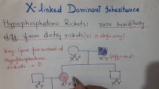 X Linked Dominant Inheritance  Hypophosphatemic Ricket  Vitamin D Resistance Rickets [upl. by Eniluj191]