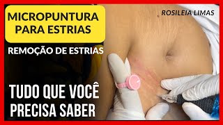 MICROPUNTURA PARA ESTRIAS REMOÇÃO DE ESTRIAS  Rosileia Limas [upl. by Annawt]