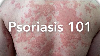 EVERYTHING to Know About Psoriasis  Dermatologist Explains [upl. by Eenimod]