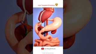 Liver transplant Procedure Animation Video [upl. by Jorrie45]