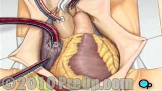 Coronary Artery Bypass CABG Surgery [upl. by Slack264]