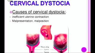 Cervical dystocia [upl. by Anivlem696]