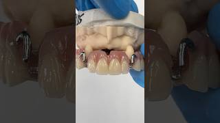 Clasping to the Canines EnvisiontecMain envisiontec lsk121shorts dentist teeth [upl. by Temhem]