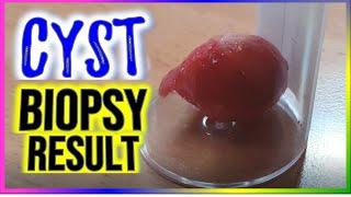 Sebaceous Cyst Excision  Checkup  Biopsy  April 2024 [upl. by Shina]