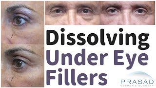 How Excessive Cosmetic Filler Under the Eyes can be Dissolved [upl. by Nalrah]