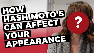 HASHIMOTOS DISEASE SYMPTOMS How it affects my appearance [upl. by Madancy]