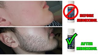 Growing a Beard from Nothing  Minoxidil Beard Transformation  Full 2020 Timeline [upl. by Hecklau]