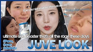 JuveLook weekly review See results for pores acne scars and elasticity all at once [upl. by Dolloff]