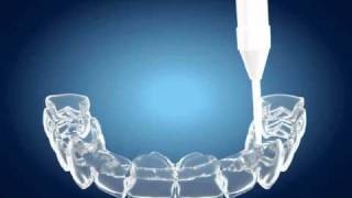 Tooth Whitening  Home Bleaching [upl. by Marv792]