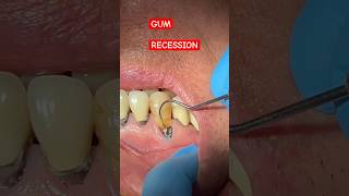 GUM RECESSION Cavity CL 5 Cavities  Tooth Vlog [upl. by Dawes867]