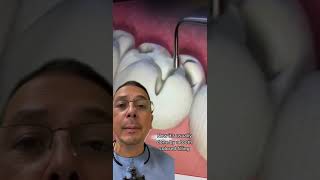 How Does a Dentist Fill a Cavity  View Mobile Dental [upl. by Saimon593]