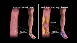 Peripheral Artery Disease Angioplasty [upl. by Yellek]