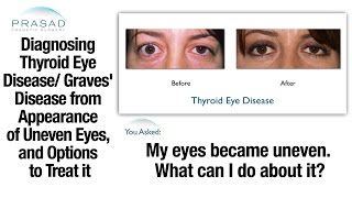 Thyroid Problems can Cause Uneven Eyes  Diagnosis and Eye Surgery Important Before Cosmetic Surgery [upl. by Yllil]