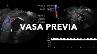 TMT Fetal Imaging by Dr Alpana Joshi Vasa Previa [upl. by Heman769]