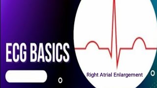 ECG Basics  Right Atrial Enlargement  ECG Changes in Right Atrial Enlargement [upl. by Feola]