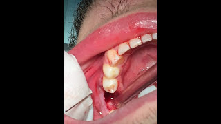 How to pull a broken tooth  First Molar extraction  قلع جراحي [upl. by Salome]